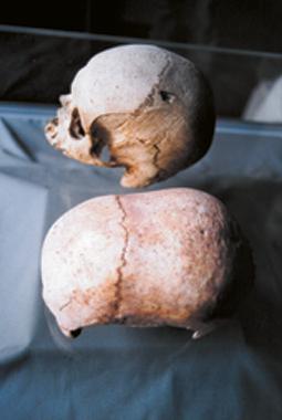 Elongated skull from Malta