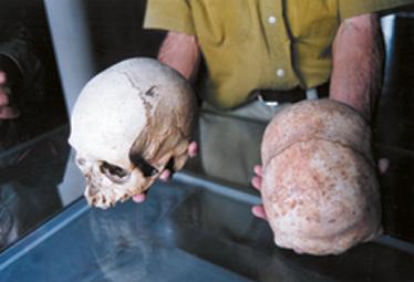 Elongated skulls from Malta